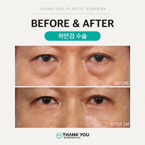 중년눈성형, 하안검수술비용 알아보기 전 이것만은 알고 가세요 관련 이미지 6