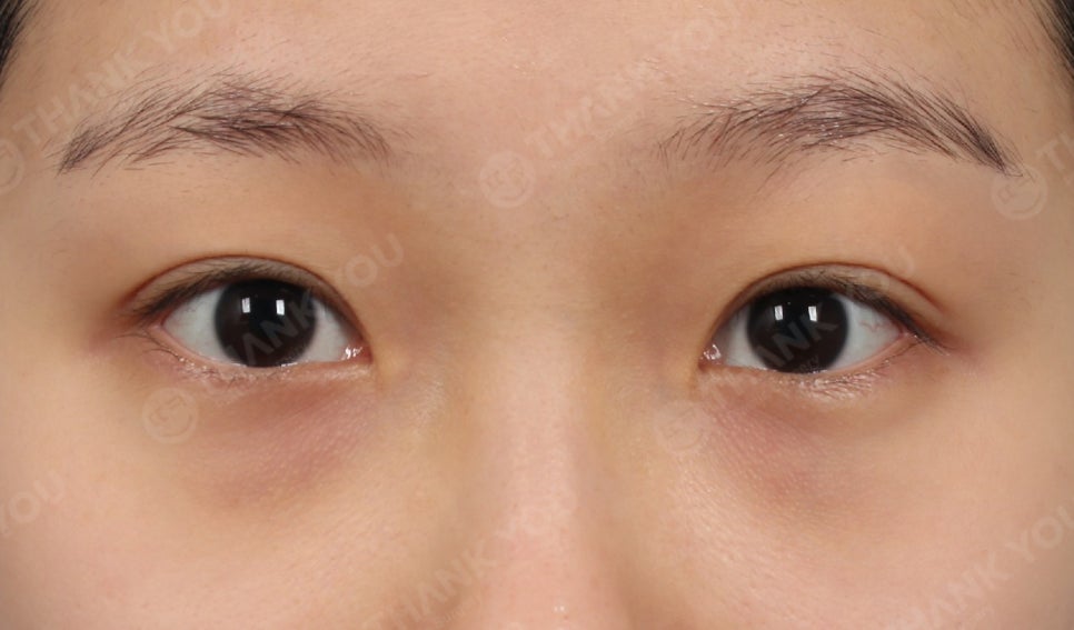 눈밑지방재배치 앞광대 지방이식이 필요한 이유? 관련 이미지 6