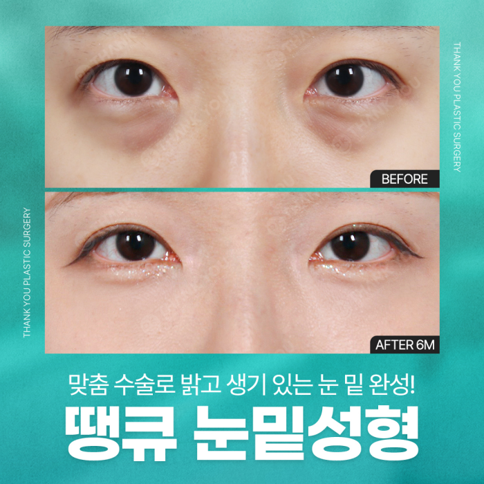 Lower Blepharoplasty and Under-Eye Fat Repositioning: What’s the Difference? image 1