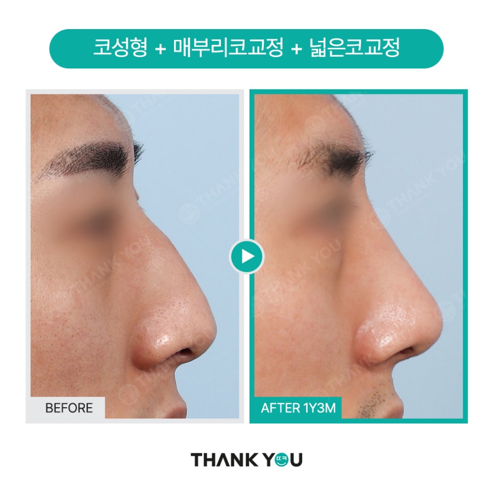 신논현역 성형외과, 남자 휜코성형, 매부리코 성공 포인트는? 관련 이미지 6