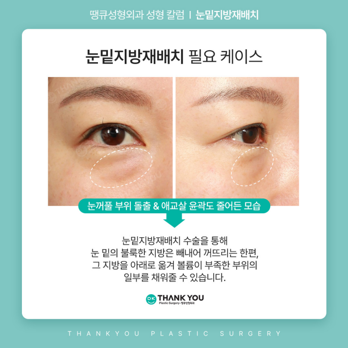 눈밑지방재배치수술만으로 볼륨이 부족하다면? 관련 이미지 2