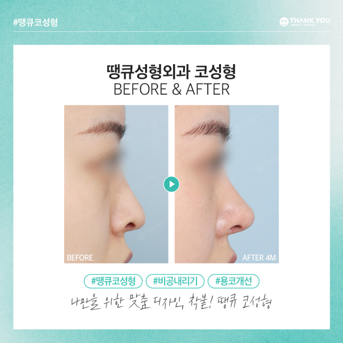 비공내리기로 용코교정하고 조화로운 코 만들기🍀 관련 이미지 8