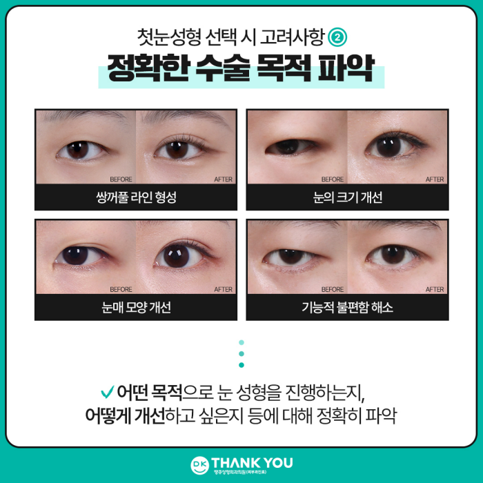 What Should You Check for First-Time Eye Surgery to Achieve Natural and Beautiful Eyes? image 3