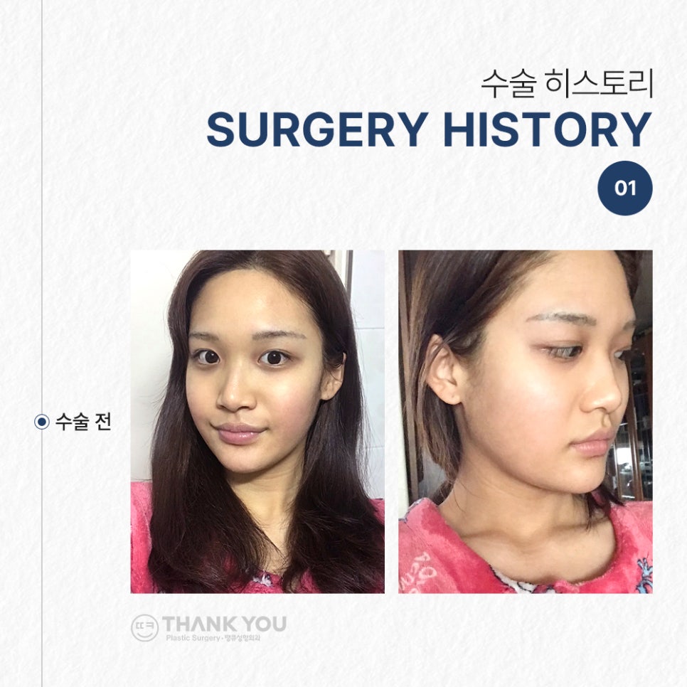 눈코성형 같이 하고싶다면? (자연유착 윗트임+콧불축소) 관련 이미지 5