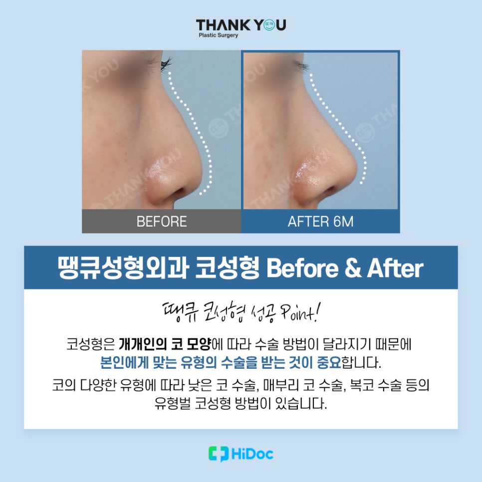 코성형 종류, 보형물과 콧대 라인까지 니즈 체크 관련 이미지 4