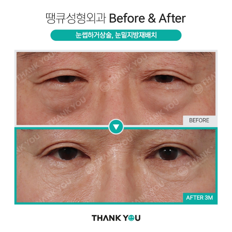 눈밑지 지방이식? 앞광대지방이식 필요한 이유? 관련 이미지 12