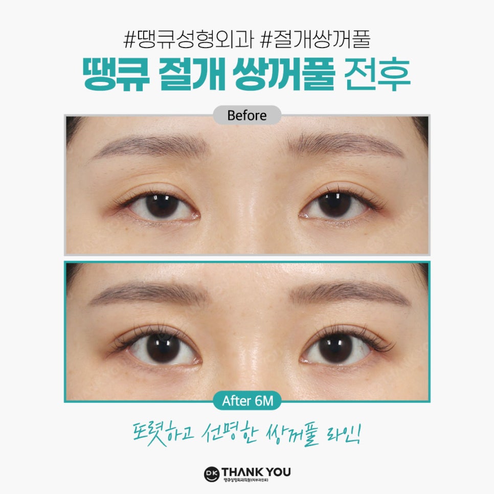 쌍꺼풀잘하는병원 땡큐에서 알려주는 절개vs비절개 수술법의 특징! 관련 이미지 5