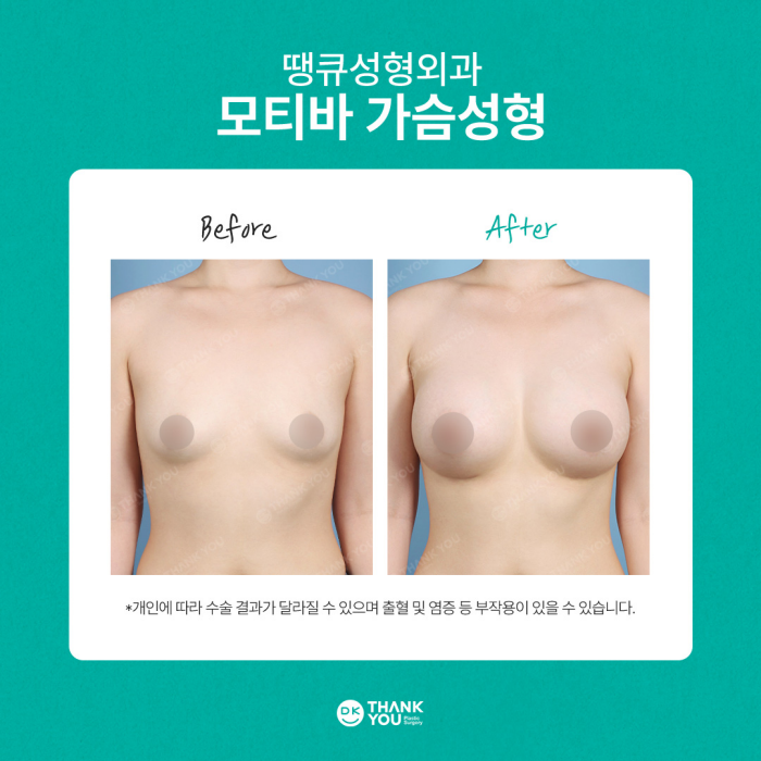 땡큐성형외과 모티바가슴성형 이벤트✨ 관련 이미지 9