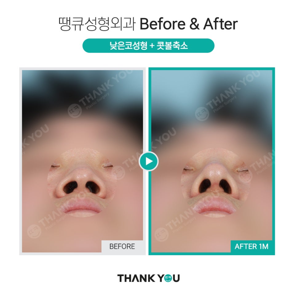 코 재수술시 기존 실리콘은 꼭 제거해야 되나요? 관련 이미지 7