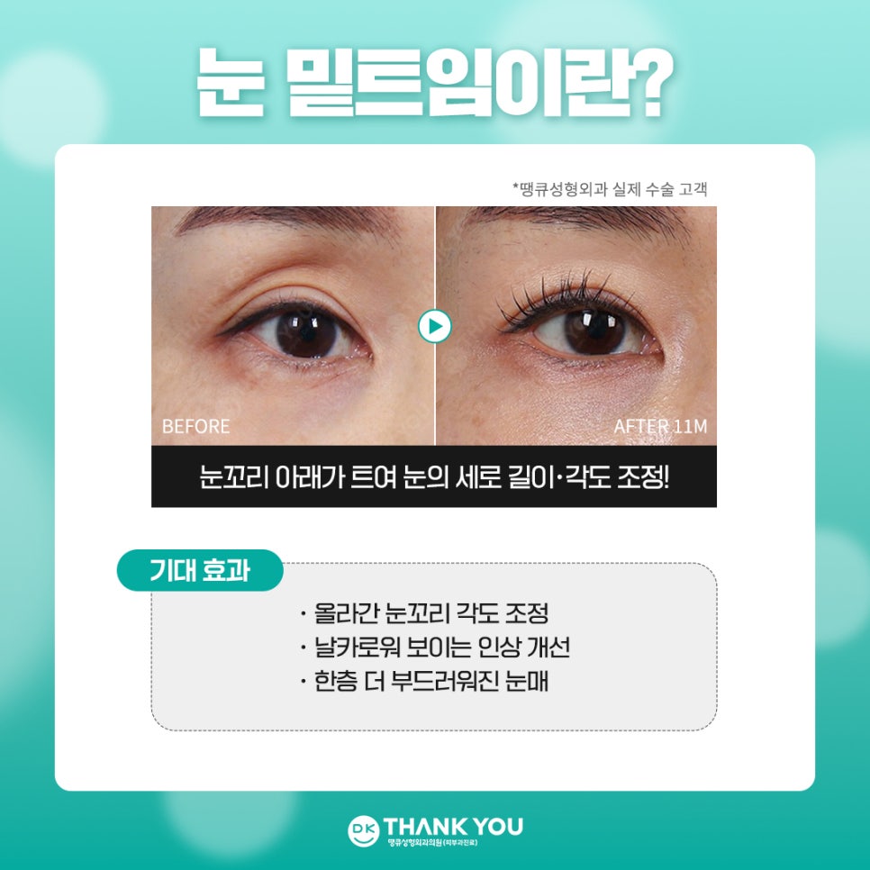 눈트임수술 [땡큐 팝콘트임]으로 듀얼트임 효과내기✨ 관련 이미지 5