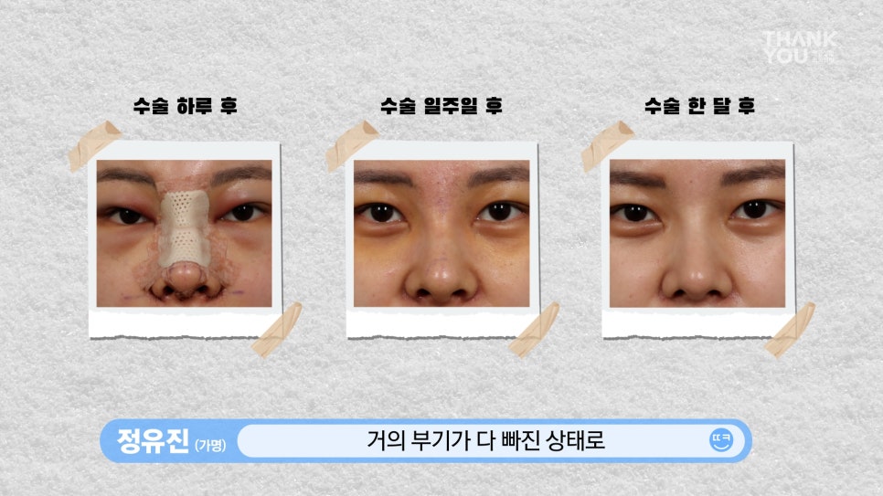 뚱뚱한 코 탈출! 실리콘 코성형👃(직원 코성형 브이로그2탄) 관련 이미지 15