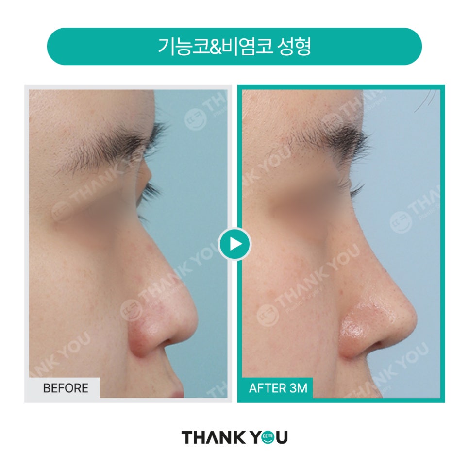 2분만에 막힌 코 뻥 뚫어주는 코블레이션 [ft.비염코성형 전후] 관련 이미지 24
