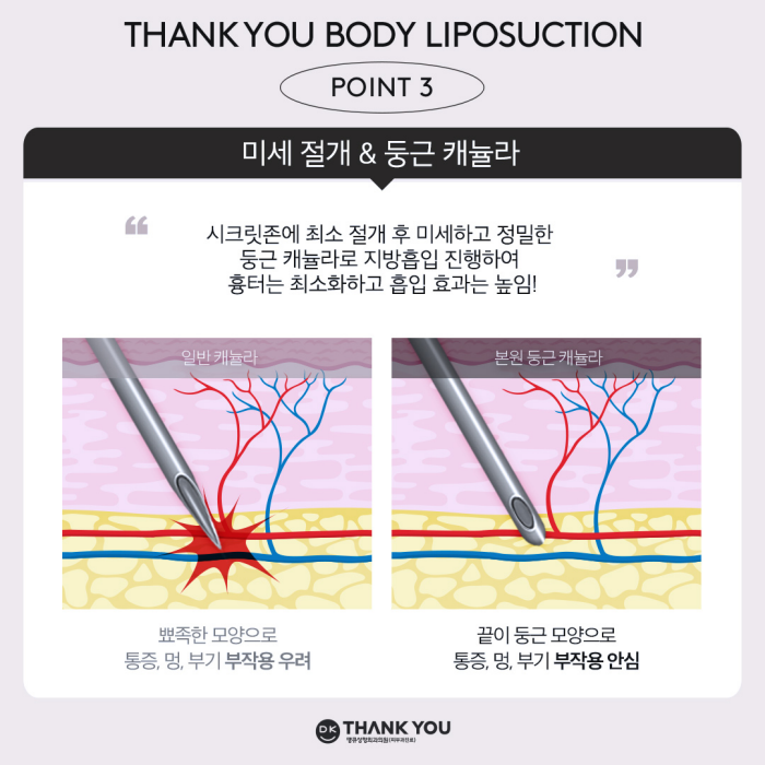 Difference Before and After Liposuction? See the Results with Thank You 1-Point Liposuction! image 4