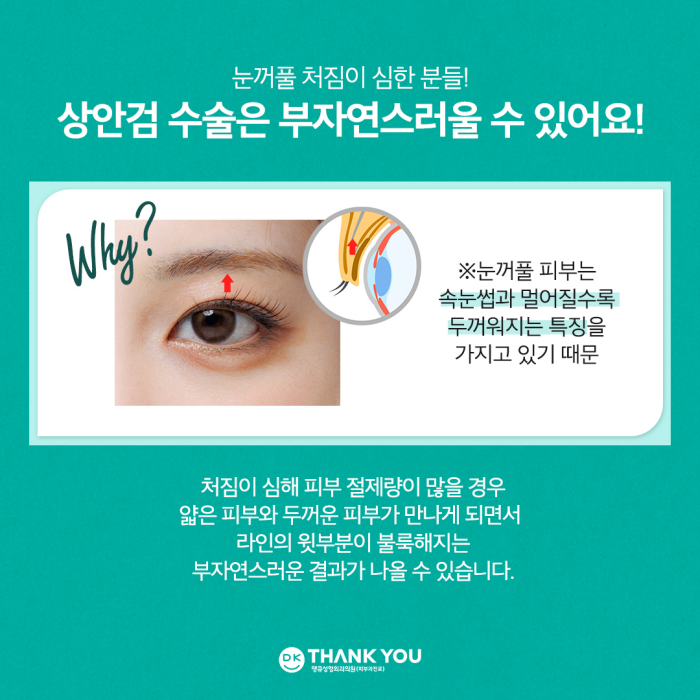 눈썹거상술 & 자연유착쌍꺼풀로 처진 눈꺼풀 효과적으로 개선! 관련 이미지 3