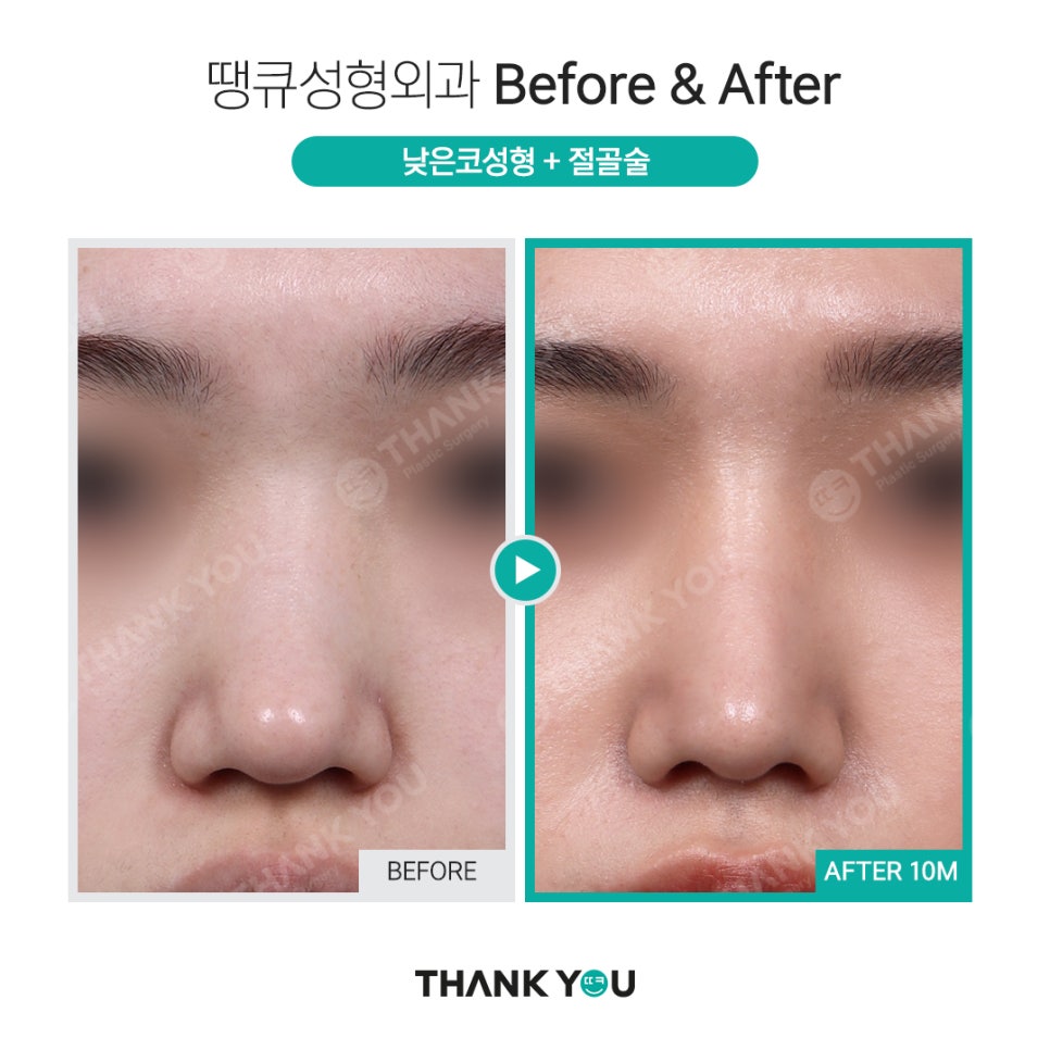 휜코 성형, 휜코 교정 과연 간단할까?(비포&애프터) 관련 이미지 9