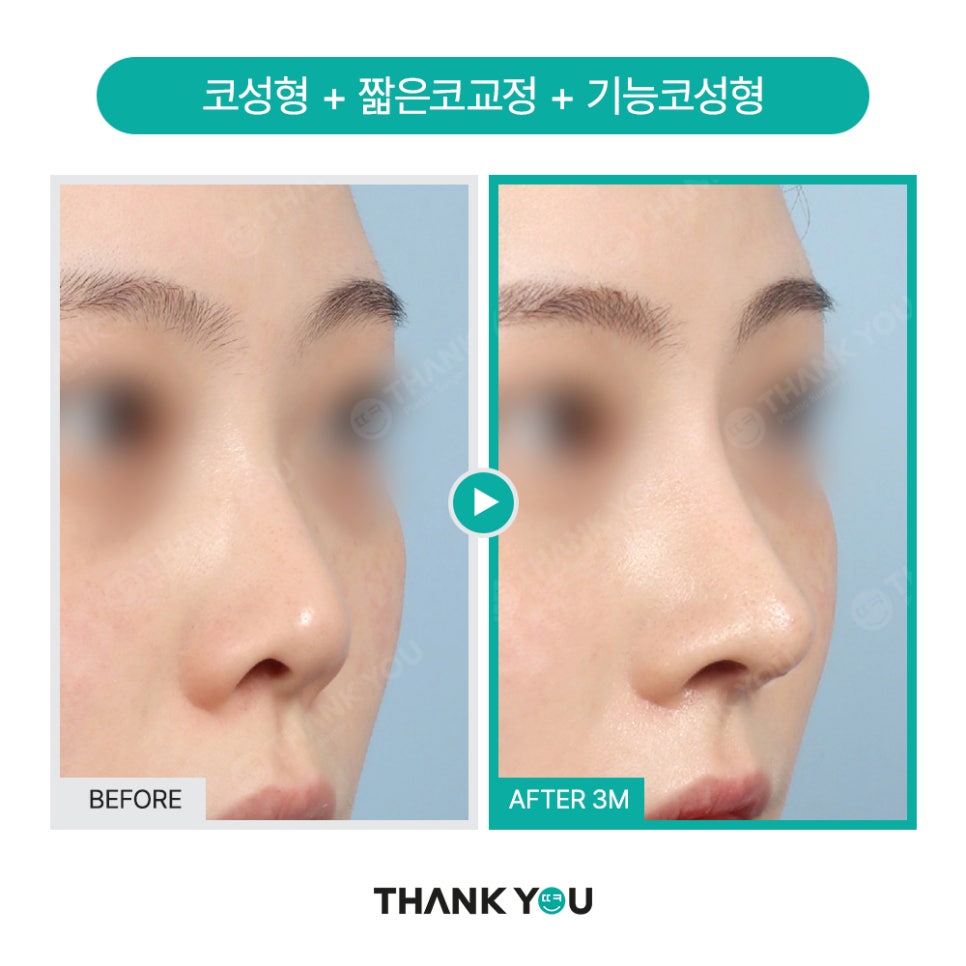 신논현역 성형외과, 남자 휜코성형, 매부리코 성공 포인트는? 관련 이미지 2