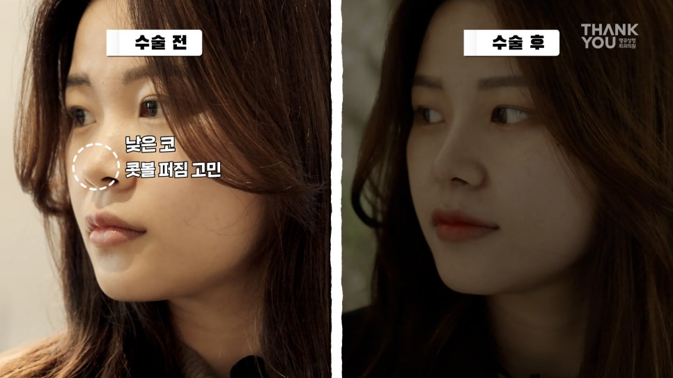 뚱뚱한 코 탈출! 실리콘 코성형👃(직원 코성형 브이로그2탄) 관련 이미지 16