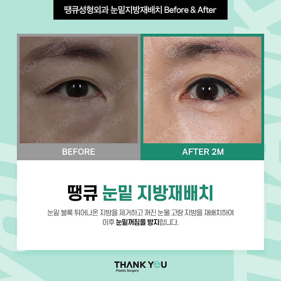 눈밑지 눈밑지방제거, 하안검 차이점은? (눈밑 비포&애프터) 관련 이미지 7