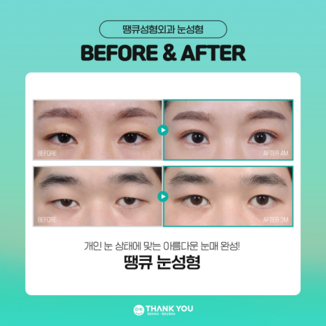 쌍꺼풀수술병원에서 알려주는 눈성형 성공 포인트! 관련 이미지 8