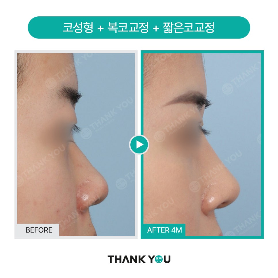 코성형 아직도 L자보형물? 실리콘 선택 기준은? 관련 이미지 7