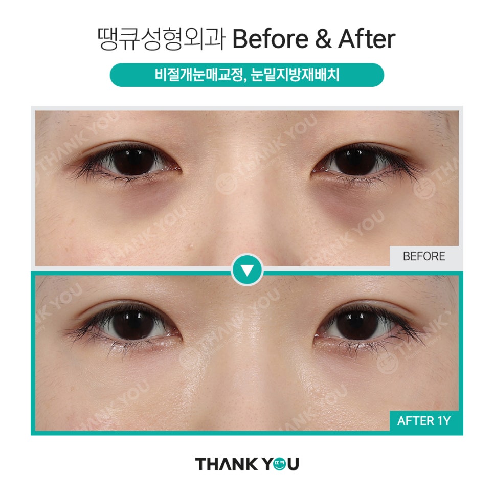 하안검과 눈밑지방재배치의 차이점? 관련 이미지 13