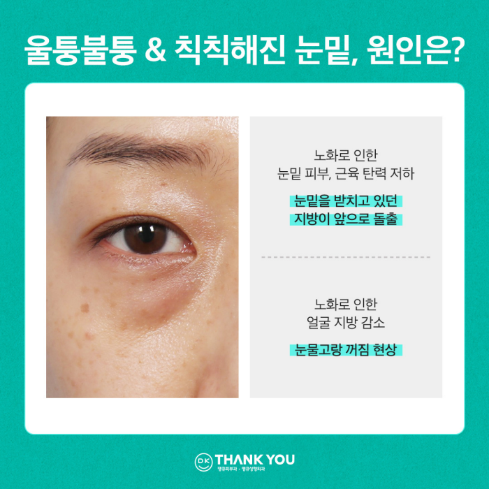 눈밑꺼짐수술? 눈밑지병원에서 내게 딱 맞게! 관련 이미지 2