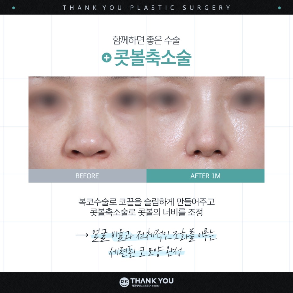 A Great Bulbous Nose Surgery Review: Making a Slim Nose at Thank You! image 8
