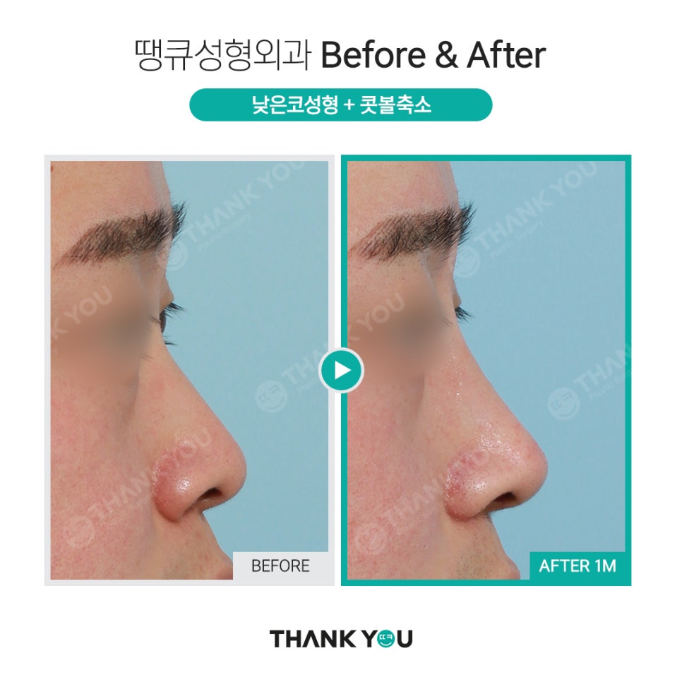 코 재수술시 기존 실리콘은 꼭 제거해야 되나요? 관련 이미지 9