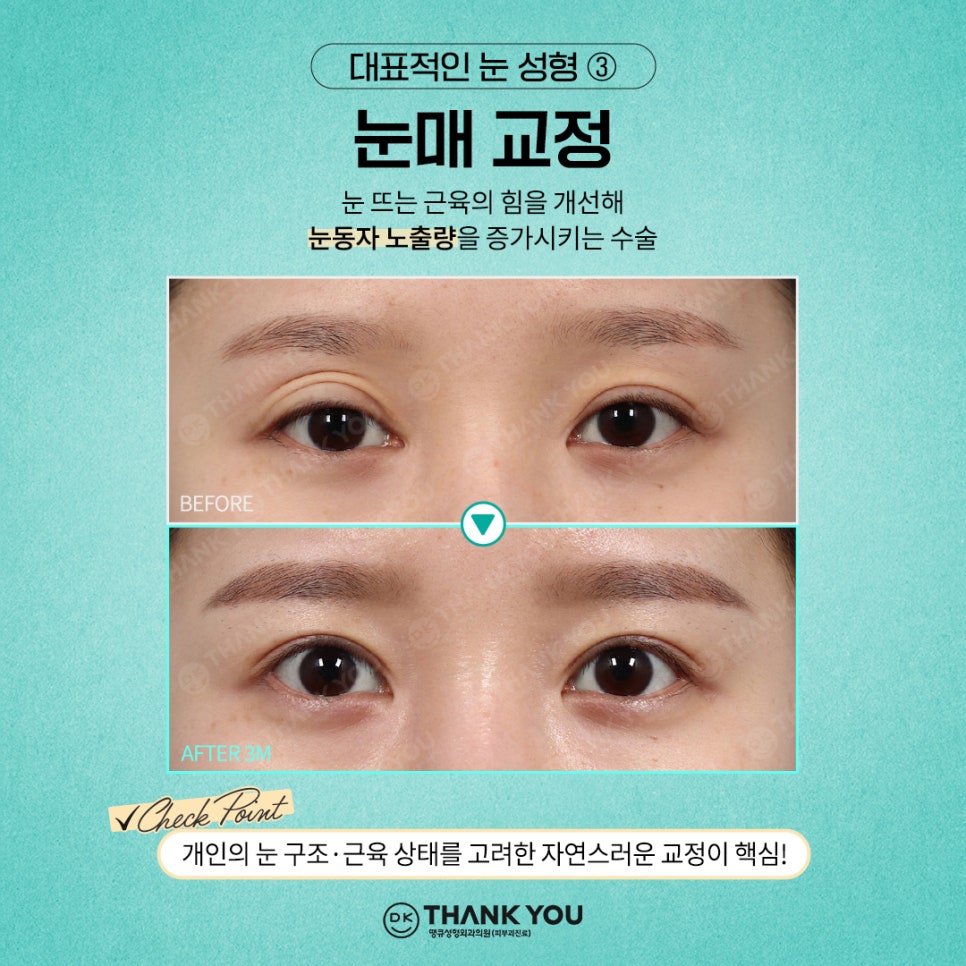 첫눈성형 후기 좋은 땡큐에서 만드는 예쁜 눈매💚 관련 이미지 8