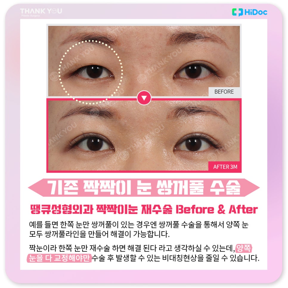 강남 눈재수술, 짝짝이눈 교정 방법 라인 대칭 성공 포인트 관련 이미지 6