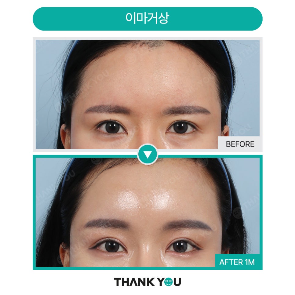 쌍꺼풀 풀림 쌍수 라인 풀림 증상? 이마거상수술로 개선! 관련 이미지 19