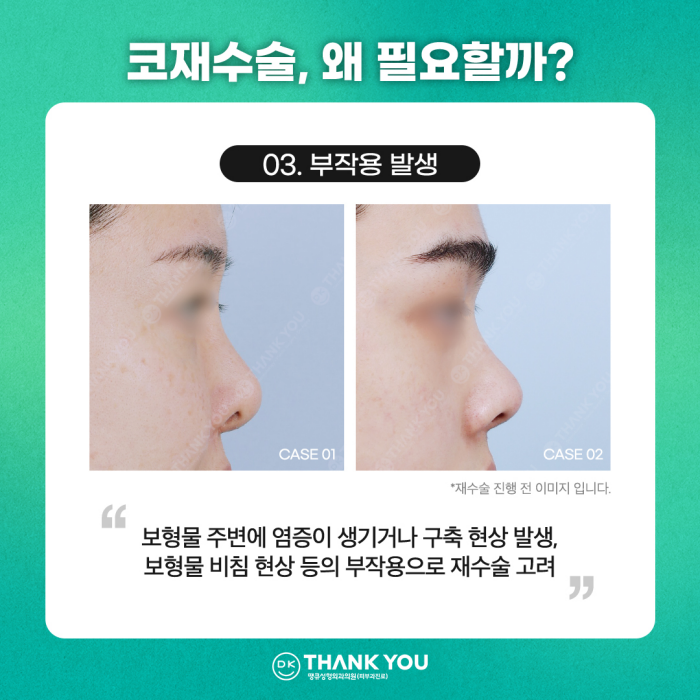 코재수술잘하는곳, 신중하게 선택해야 하는 이유는? 관련 이미지 5