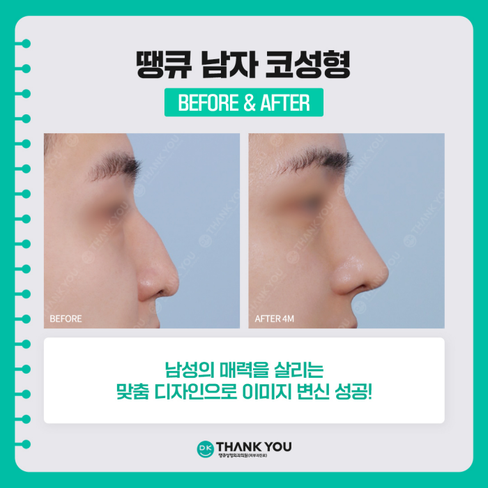 A Successful Image Transformation at Thank You, a Great Place for Male Rhinoplasty! image 7