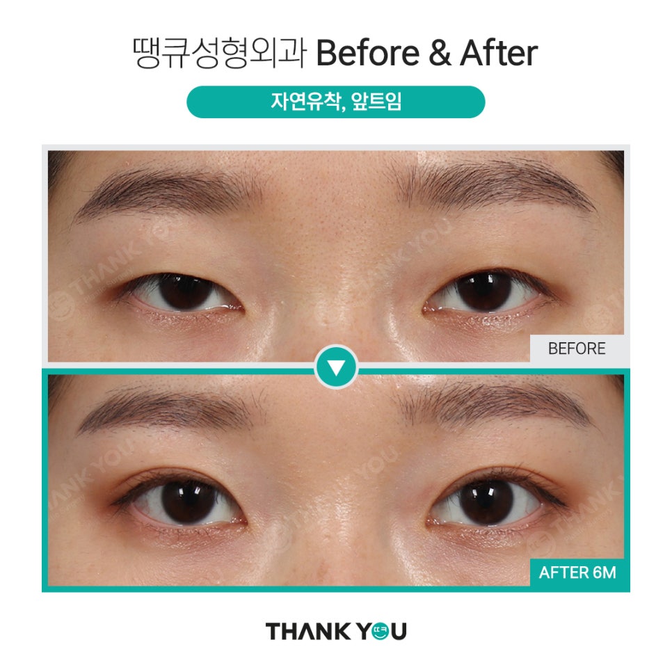 쌍수 뒷트임 (앞트임,밑트임, 듀얼트임 종류) 전후사진 관련 이미지 9