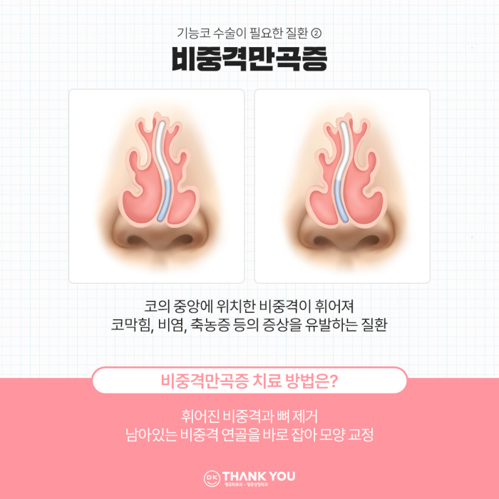 비염기능코수술과 미용코 성형을 동시에! 기능코성형 효과는?! 관련 이미지 4