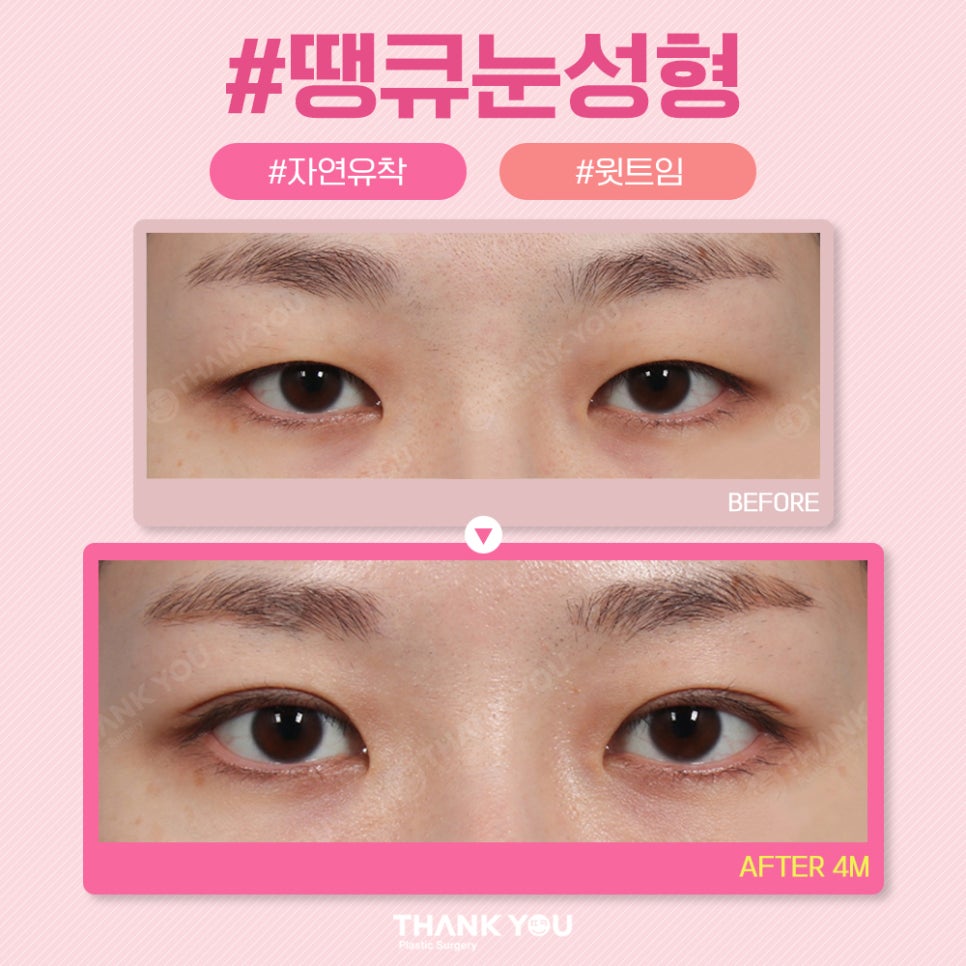 땡큐 쌍꺼풀 전후사진 비교 Before & After 관련 이미지 3