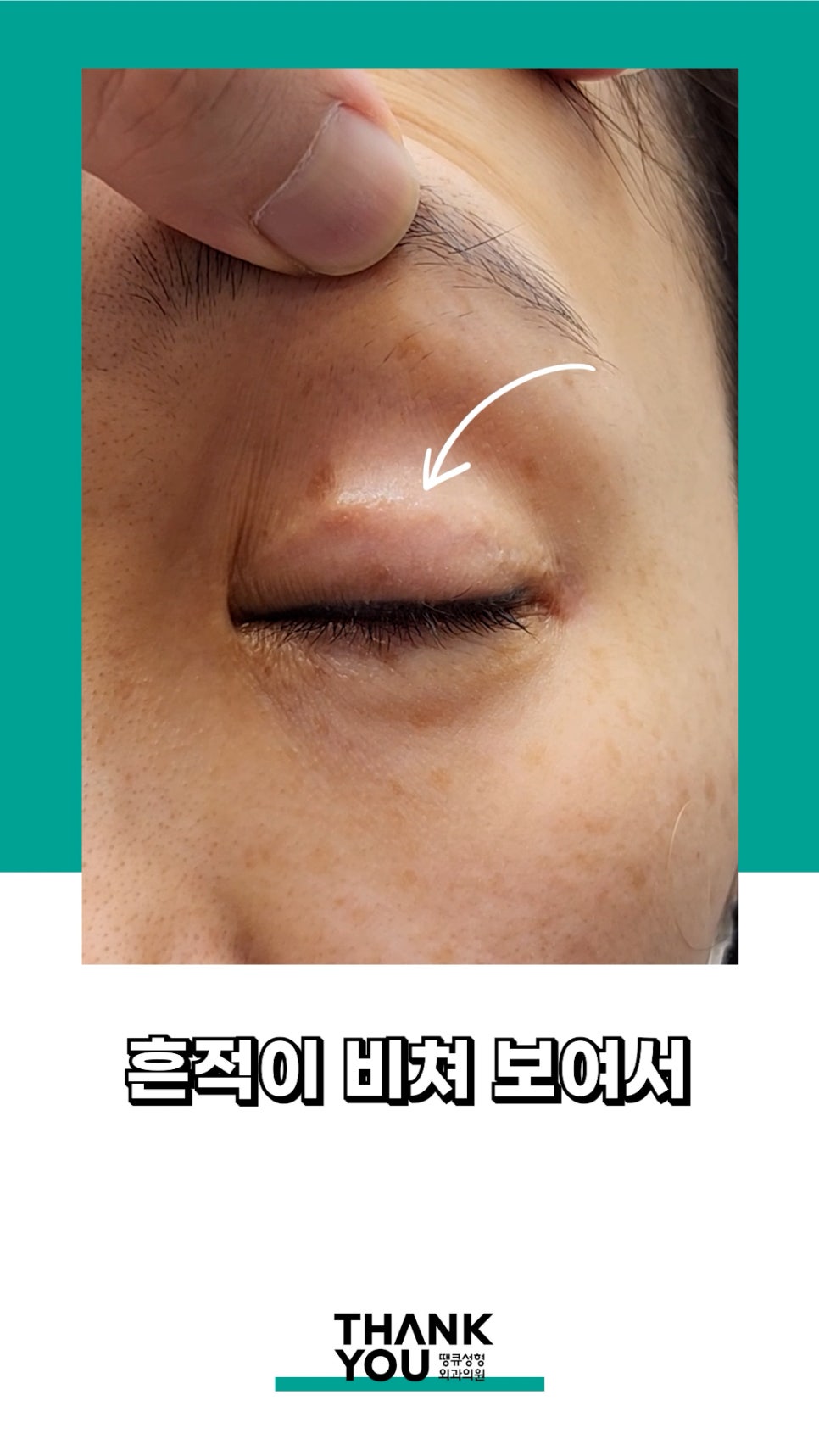3번 눈재수술? 근데 실제거를 안했다고? 땡큐에서 전부 실제거! 관련 이미지 11