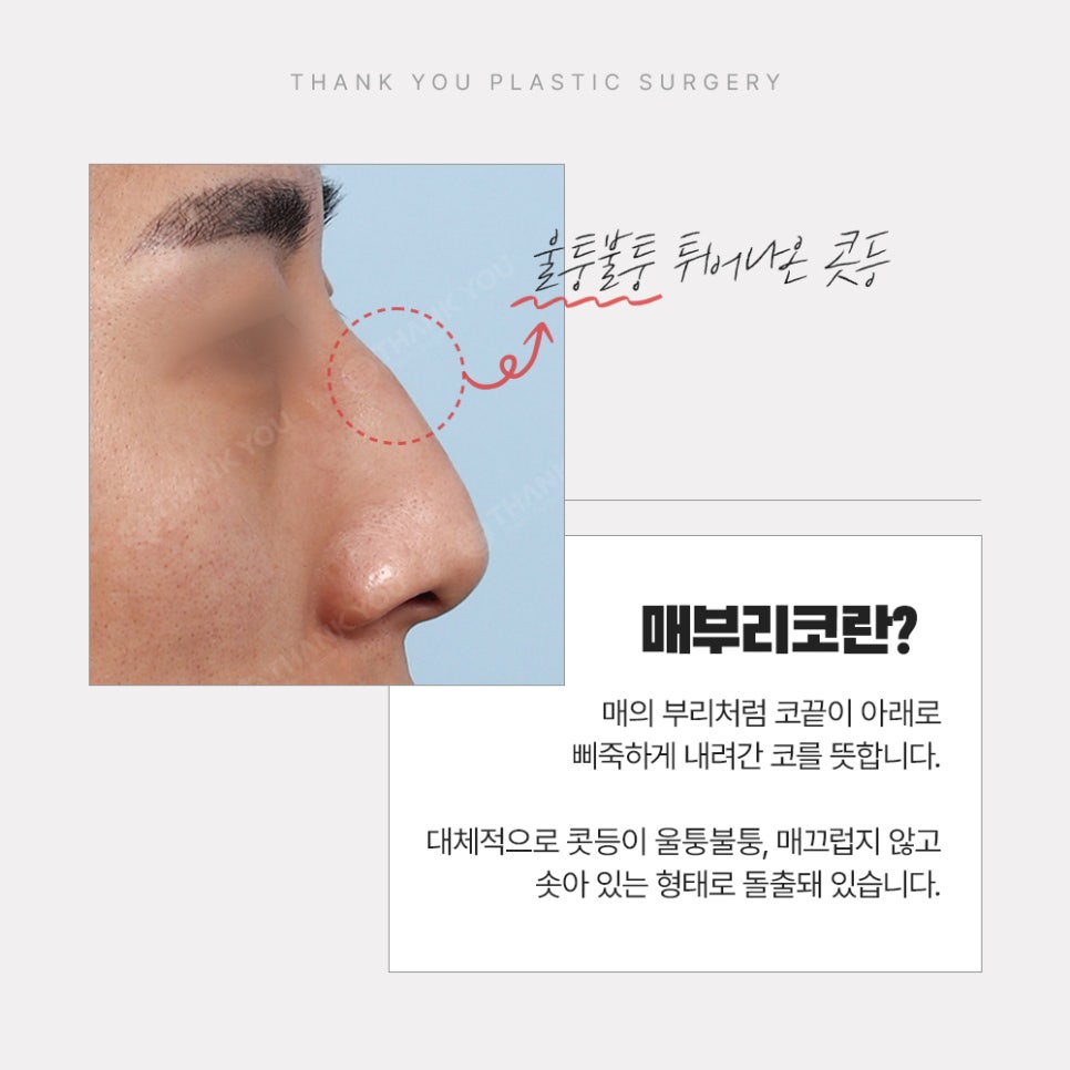 튀어나온 코? 남자 매부리코성형 솔루션 (ft. 메부리 전후) 관련 이미지 5