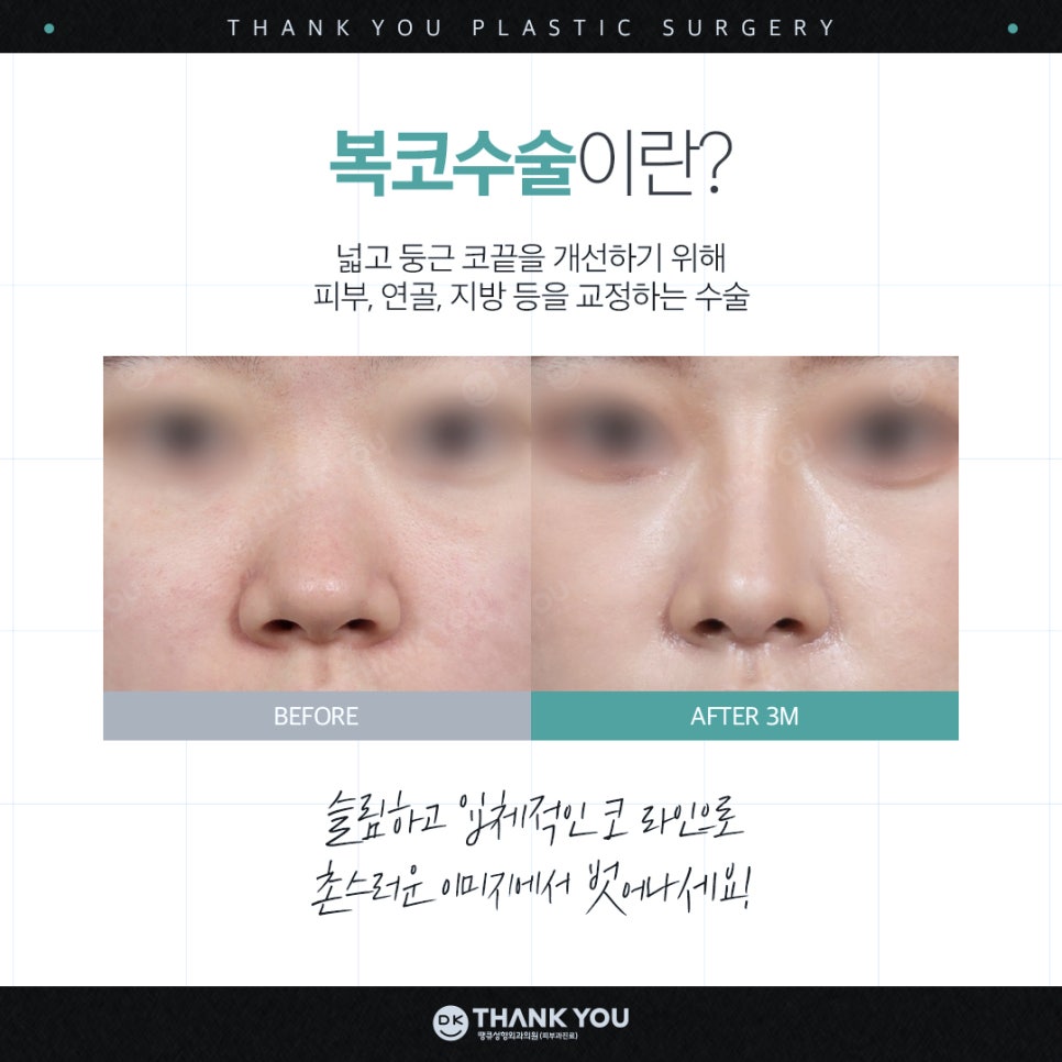 A Great Bulbous Nose Surgery Review: Making a Slim Nose at Thank You! image 2