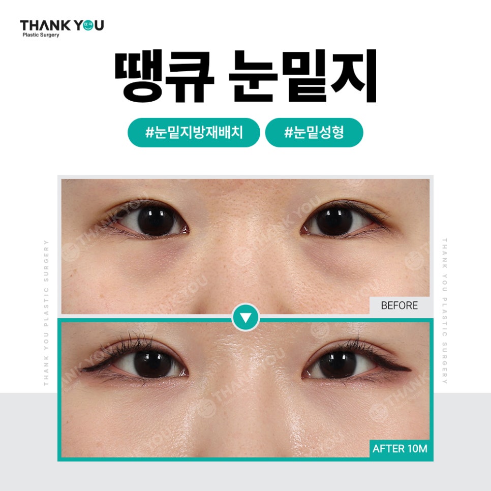 눈밑 불룩, 눈밑지 대신 눈밑지방제거만 단독으로? 관련 이미지 14