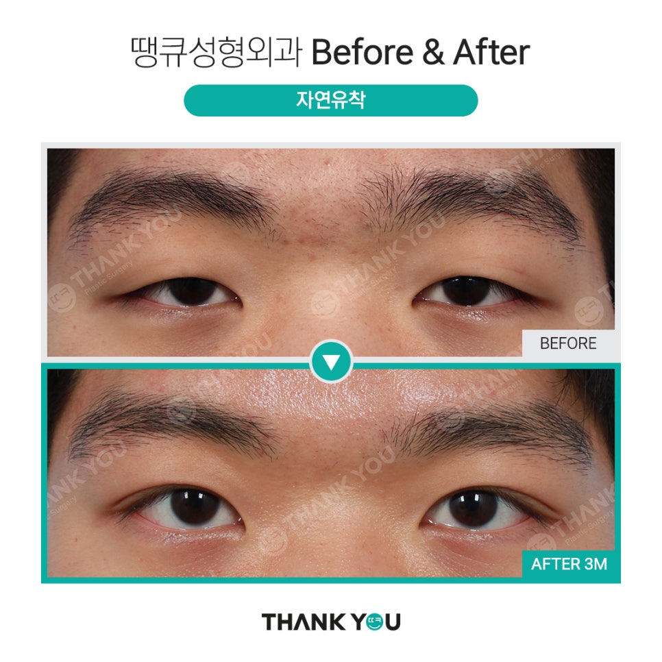 [남자 쌍수후기?] 망하기 싫으면 꼭 보세요! 관련 이미지 22