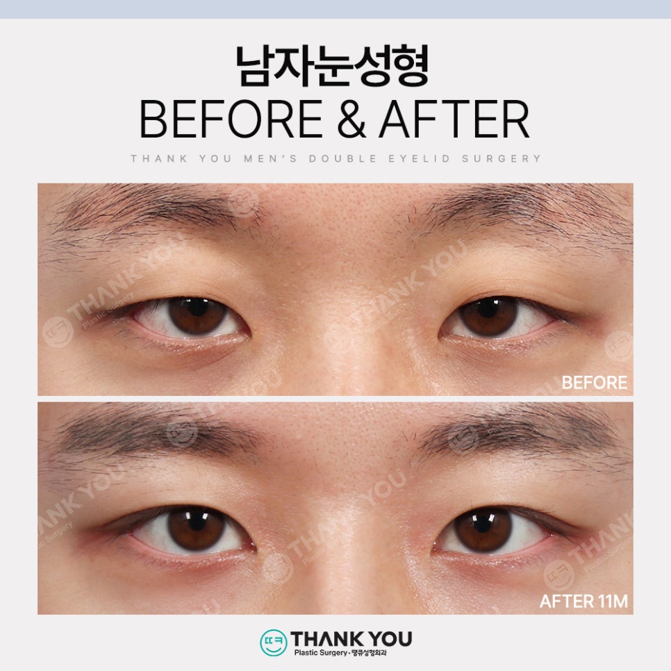 땡큐 남자눈성형 솔루션 (ft. 남자비절개 눈매교정 전후) 관련 이미지 9