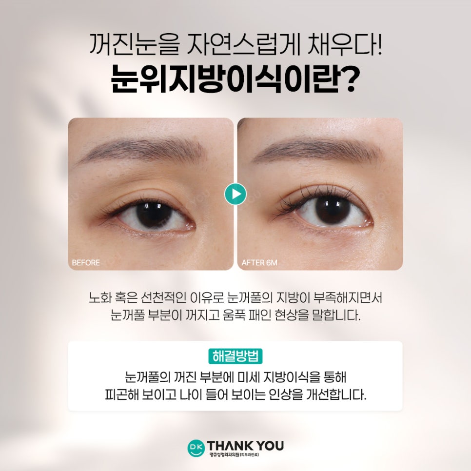 눈꺼풀꺼짐 개선하려면? 꺼진눈지방이식 전에 알아야 할 3가지 관련 이미지 3