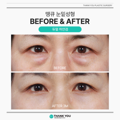 Lower Blepharoplasty and Under-Eye Fat Repositioning: What’s the Difference? image 11