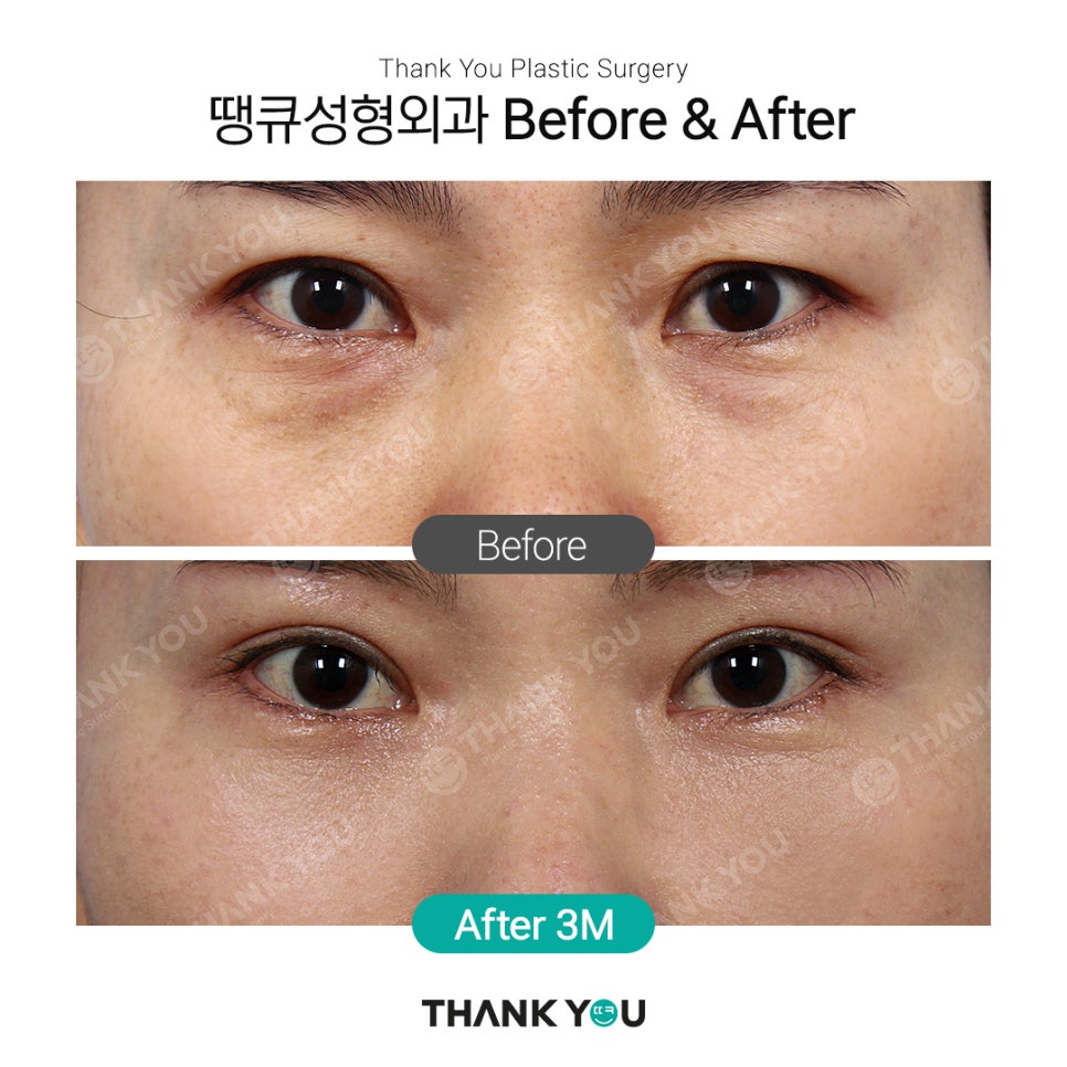 땡큐에서 알려드리는 눈밑지방재배치 Check point ❗ 관련 이미지 4