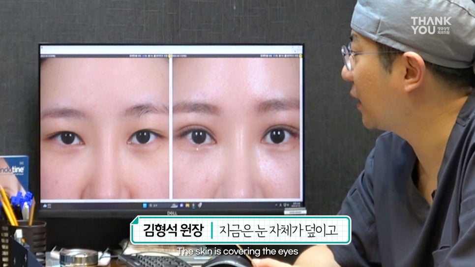 쌍수에 눈썹올림술을 추천하는 이유?! 관련 이미지 5