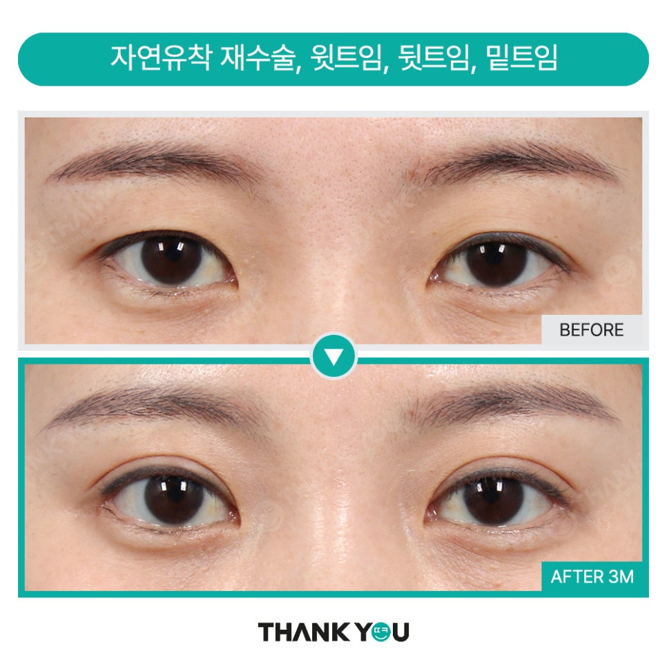 눈재수술 실패하지 않으려면? 눈 재수술유형&전후 체크 관련 이미지 9