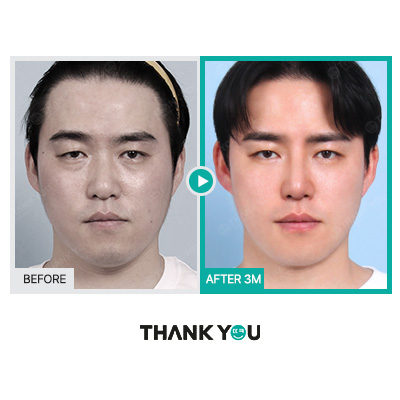 MAKE미남(맥미남) 오덕차장님의 노안 개선&남자 비염코성형 전후 관련 이미지 5