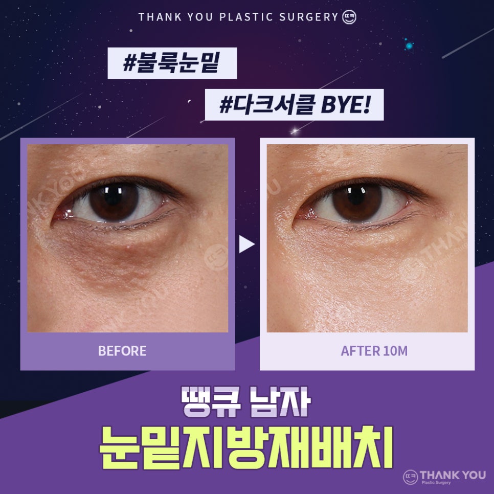붐 눈밑지방재배치? 남자 눈밑지 전후 (붐, 남창희, 김동현) 관련 이미지 9