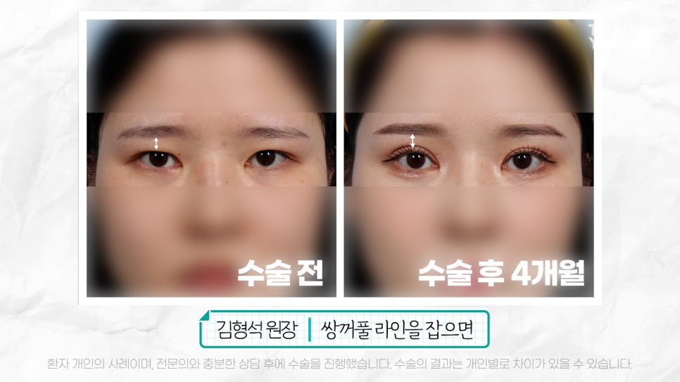 눈재수술 할 때 이마거상 추천하는 이유는? (눈썹올림술 전후) 관련 이미지 18